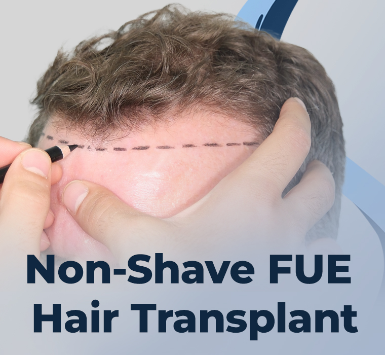 Non-Shave FUE Hair Transplant
